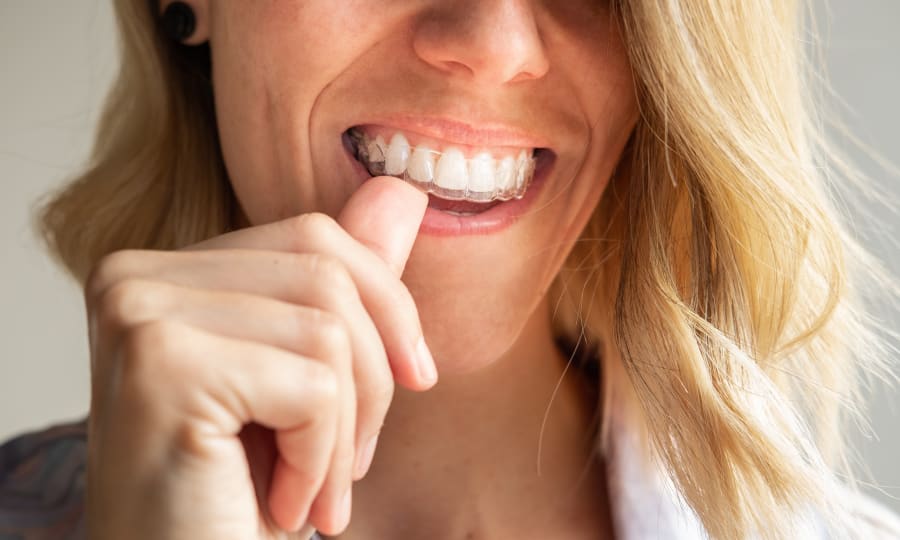 Low-Profile Aesthetics of Clear Aligners at Woodstock Orthodontics